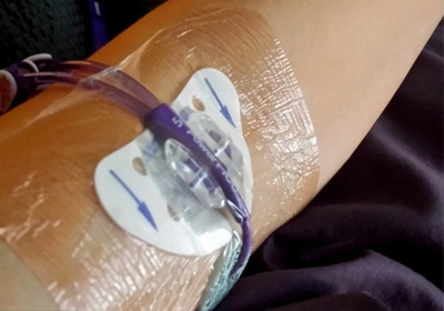 Picc Line Ou Chambre Implantable