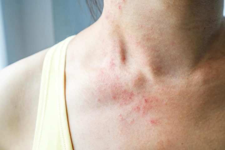 8 Symptômes De Maladie Révélés Par Votre Peau – Sélection.ca pour Demangeaison Apres La Douche