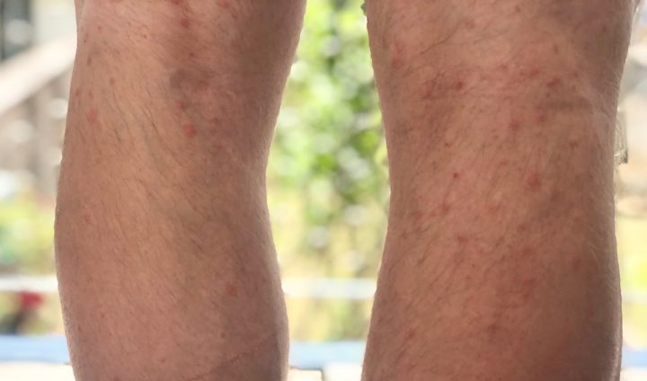 Coureurs, Cyclistes : Points Rouges Sur Les Jambes dedans Demangeaison Apres La Douche