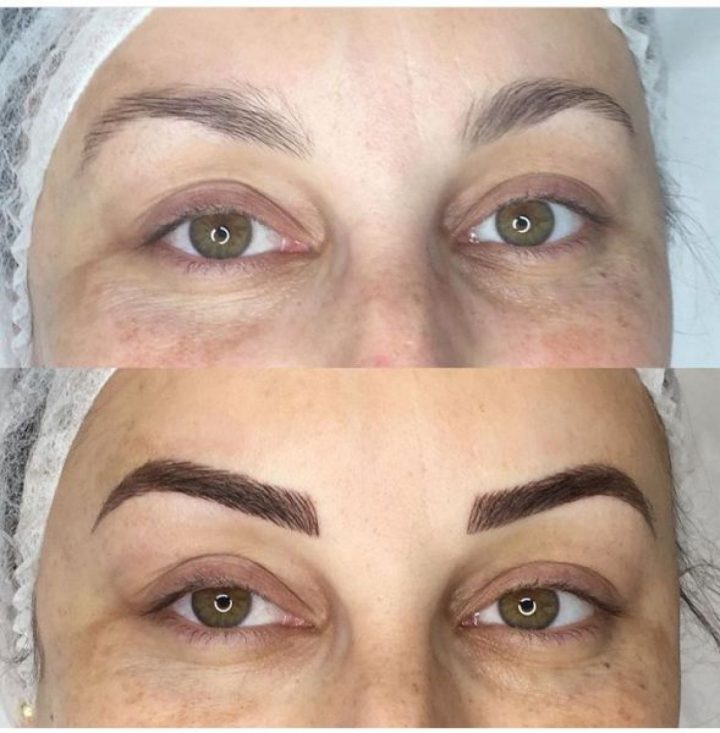 Microbalding À Lille (59) Par Mathilde – Estheca à Douche Autobronzante Lille