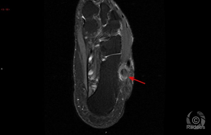 Tous Les Cas Cliniques Et E-Learning En Radiologie Et à Chambre Implantable Cip