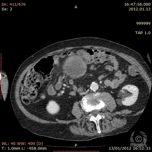 Tous Les Cas Cliniques Et E-Learning En Radiologie Et destiné Chambre Implantable Cip