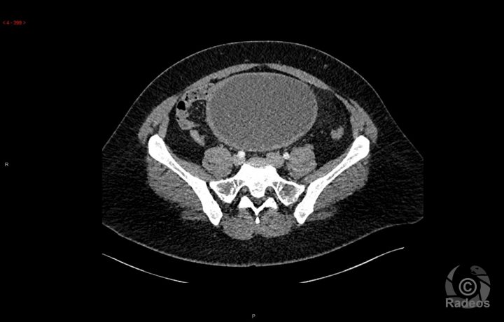 Tous Les Cas Cliniques Et E-Learning En Radiologie Et tout Chambre Implantable Cip
