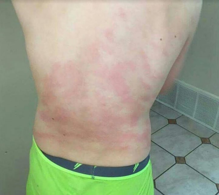 Un Garçon De 9 Ans Est Allergique À L'eau | Radio-Canada.ca avec Demangeaison Apres La Douche