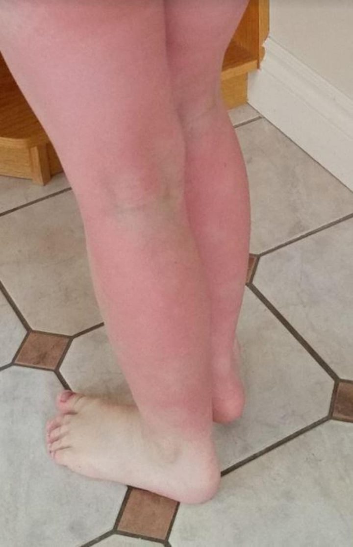 Un Garçon De 9 Ans Est Allergique À L'eau | Radio-Canada.ca tout Demangeaison Apres La Douche