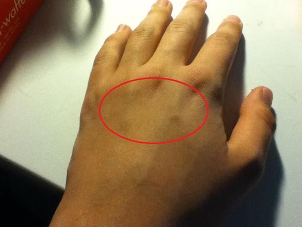 dicke adern an den händen dicke adern an den händen