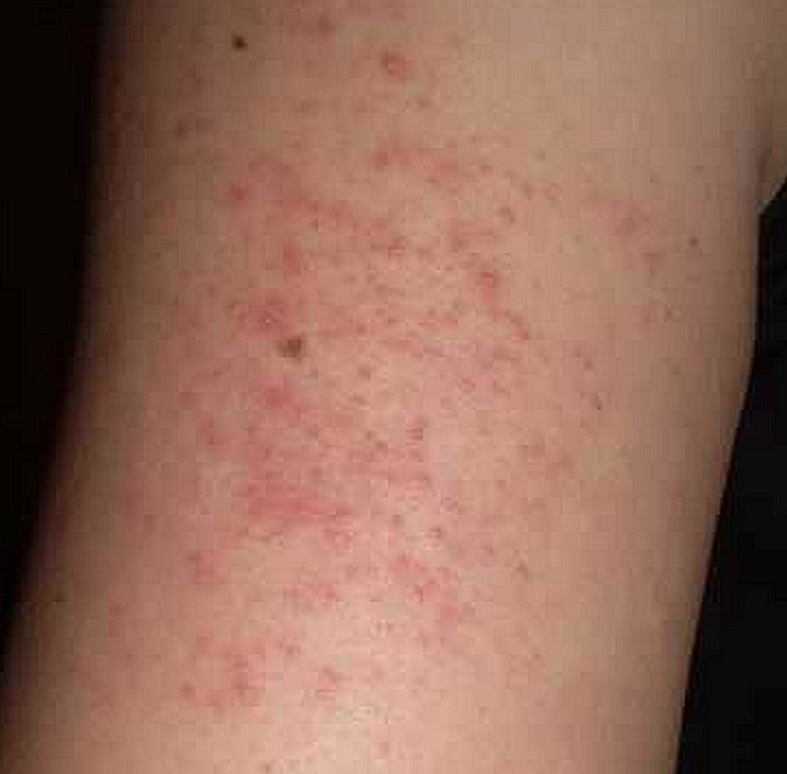 Petit Bouton Couleur Peau Qui Gratte – Choix De Couleur concernant Démangeaisons Des Testicules Petit Bouton Couleur Peau Qui Gratte – Choix De Couleur concernant Démangeaisons Des Testicules