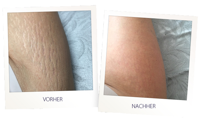 dehnungsstreifen vorher nachher dehnungsstreifen vorher nachher