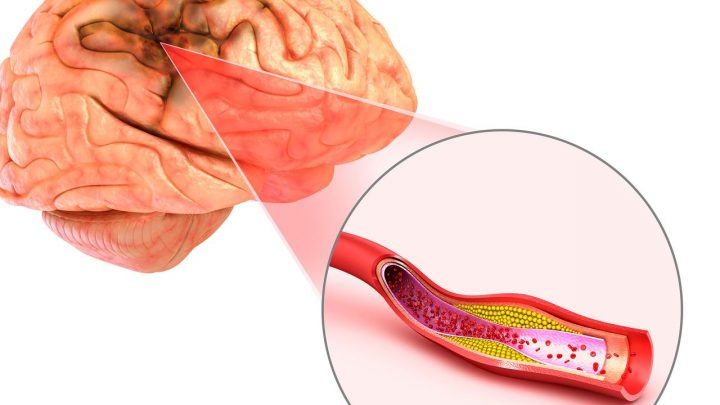 dmsa blut hirn schranke dmsa blut hirn schranke