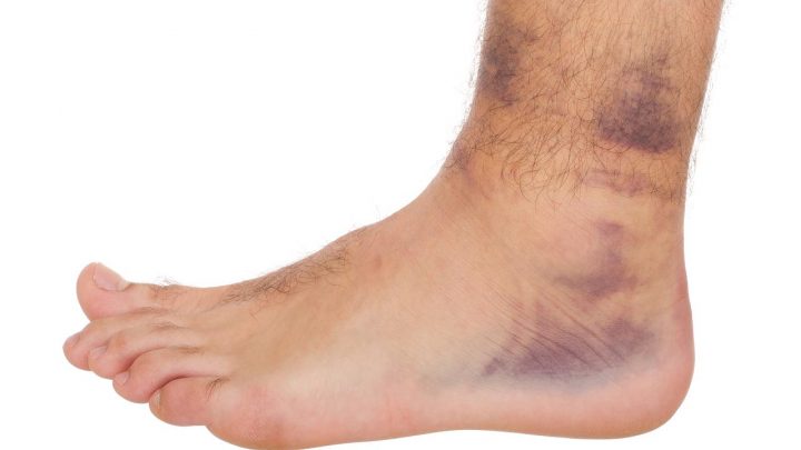 blaue flecken nach faszienmassage blaue flecken nach faszienmassage