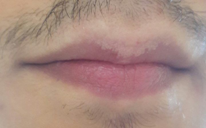 gesichtsbehaarung über der lippe