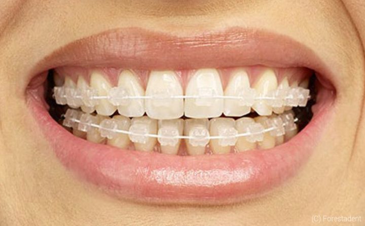 zahnspange gummis wie lange zahnspange gummis wie lange