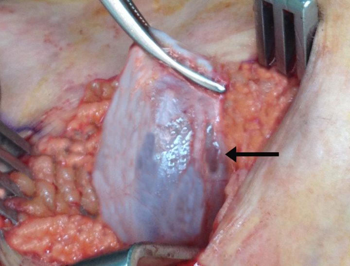 zysten an der schilddrüse zysten an der schilddrüse