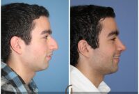 breast implants utah breast implants utah