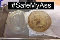 breast implant pain after 10 years breast implant pain after 10 years