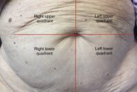 guarding abdomen examination