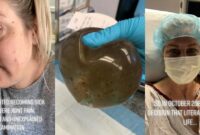 breast implants denver