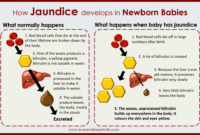 breastfeeding jaundice timeline breastfeeding jaundice timeline