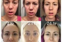 breast implant removal nhs breast implant removal nhs