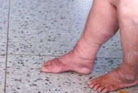 edema in legs and feet