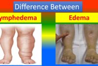 edema in legs meaning