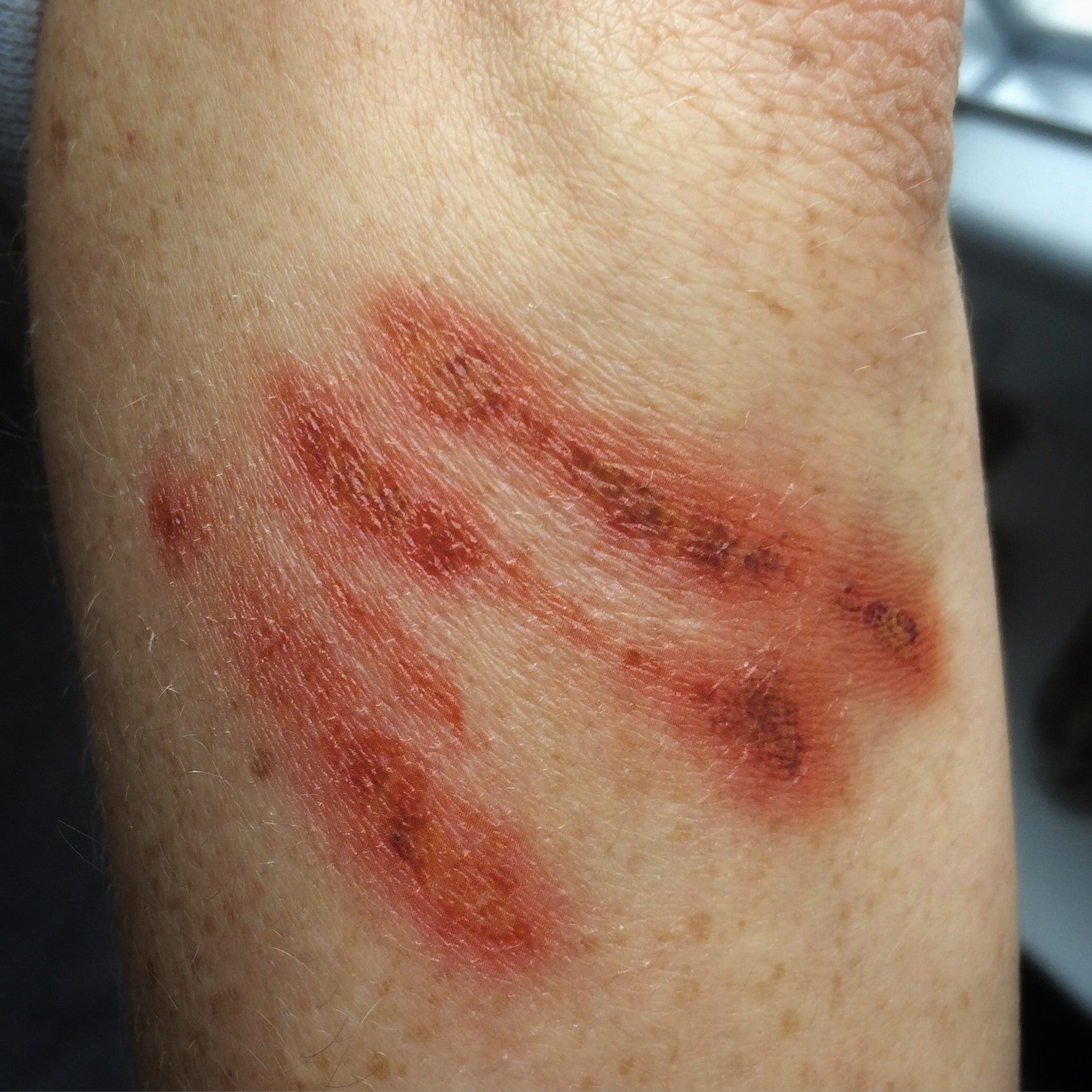 Various Wounds 2 - Random Wounds 2 – Kitchen Makeup