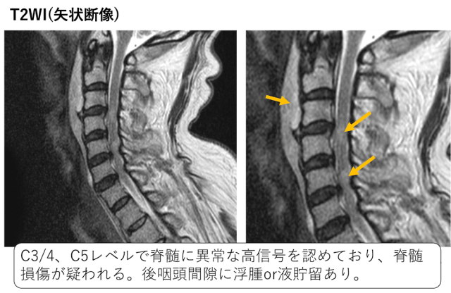脊髄損傷のCT,MRI画像診断のポイント