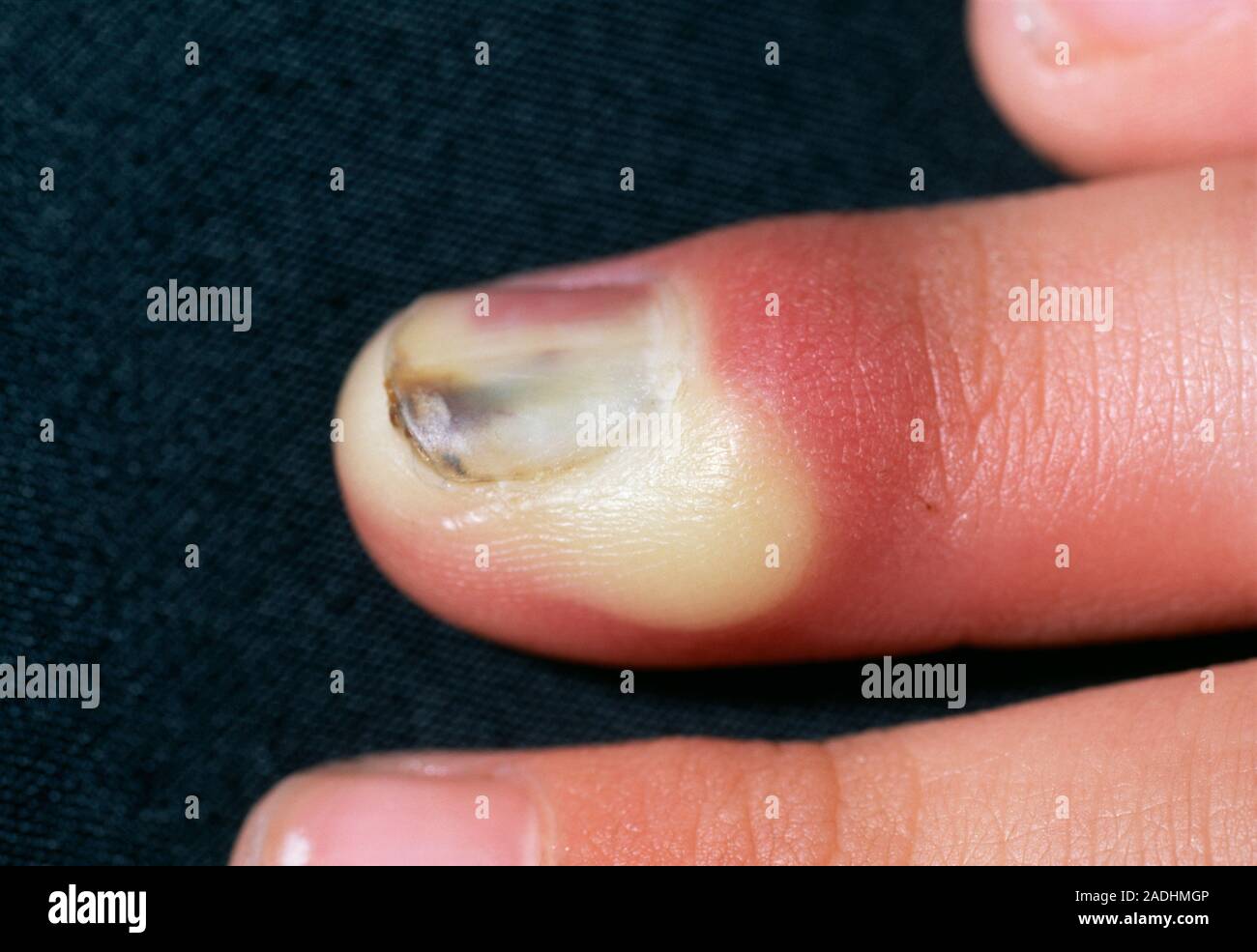 Acute paronychia. Close-up of a finger of a 5- year-old boy with