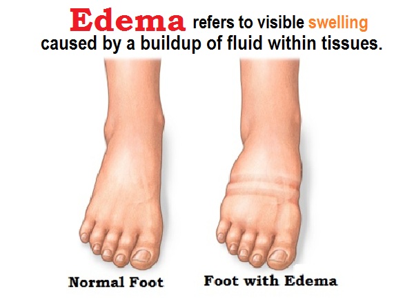 What Is Oedema | Edema: Causes, Treatment, Symptoms, and More – DXCF