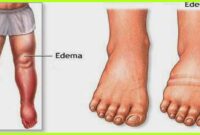 edema in legs and feet in elderly