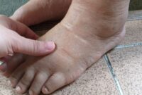 edema prevention