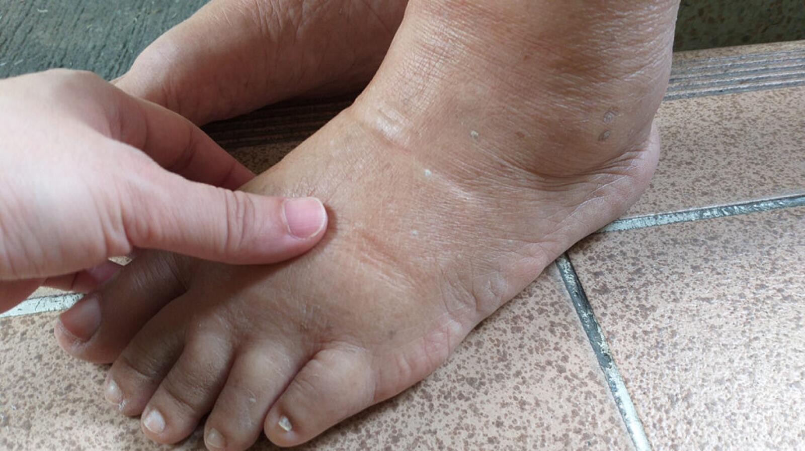 Peripheral Edema: Causes and Treatment