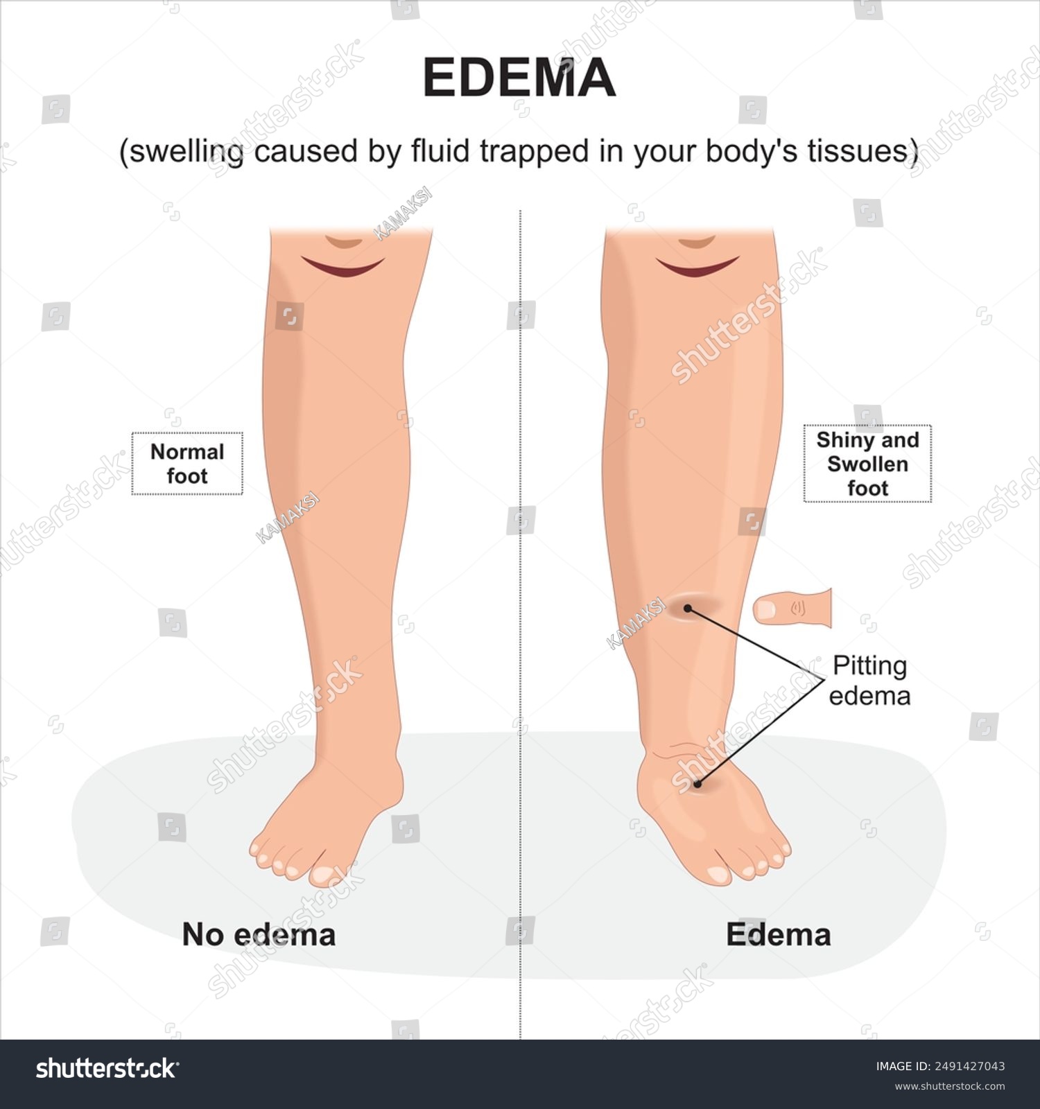Oedema Swollen Leg Illustration Pitting Edema Stock Illustration